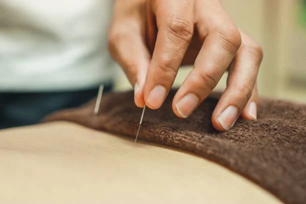 A practitioner placing acupuncture needles along a client's back