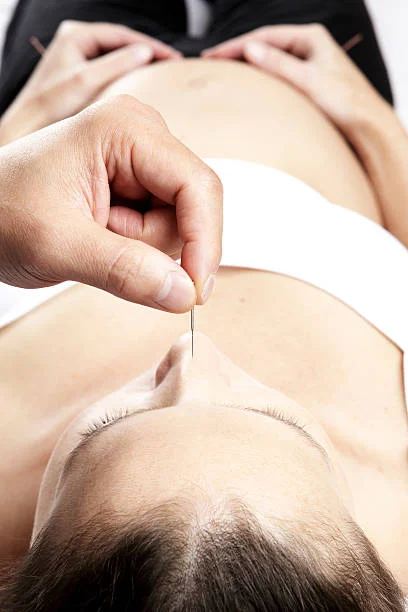 Acupuncture needles being placed on a client's abdomen