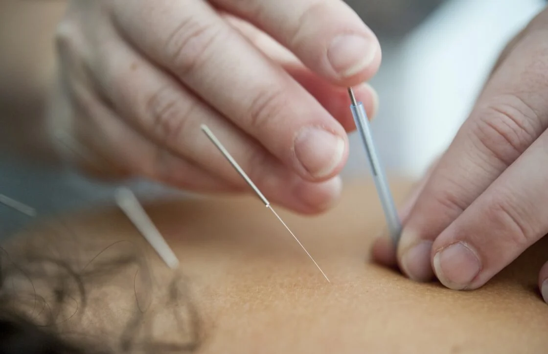 Acupuncture treatment at Peace of Mind Massage Therapy Centre in Calgary